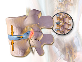 Грыжа межпозвоночного диска