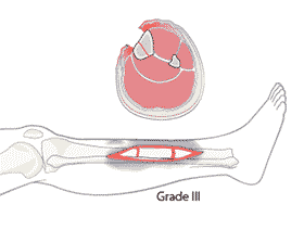 Перелома типа III по классификации Gustilo Anderson 