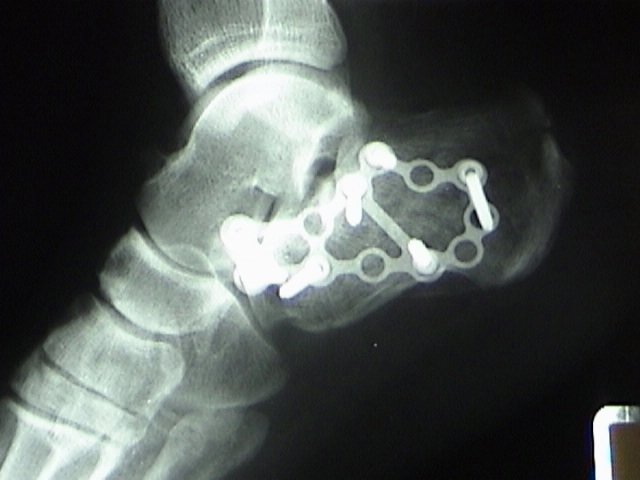 calcaneus